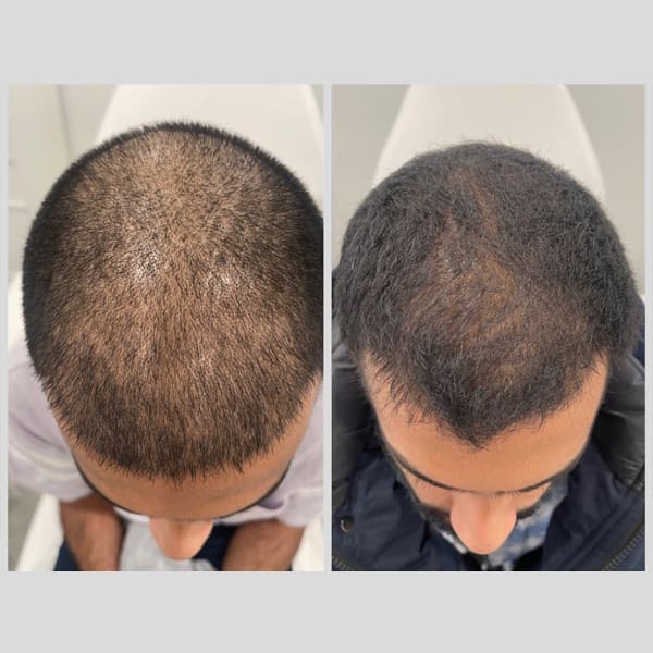 PhiloSophie Hair - Before and After shots of hair growth